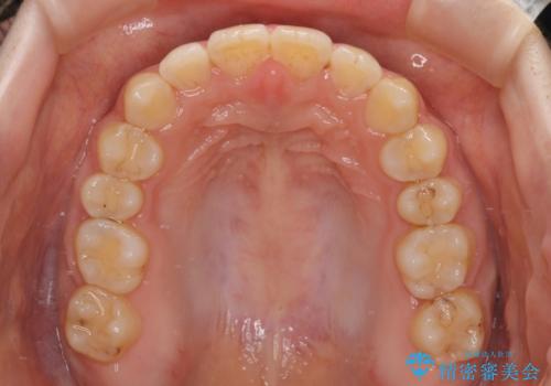 大学病院から転院 非抜歯で口元を下げるワイヤー矯正の治療後