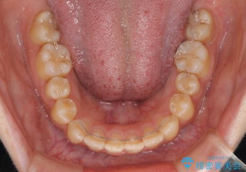 大学病院から転院 非抜歯で口元を下げるワイヤー矯正の治療後