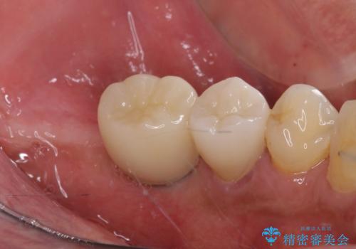 追加のインプラントと、歯肉移植による磨きやすい歯肉に改善の治療前