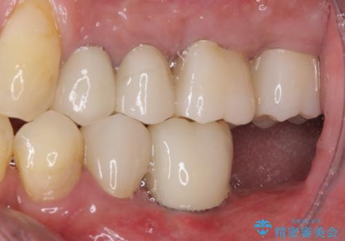 追加のインプラントと、歯肉移植による磨きやすい歯肉に改善の症例 治療前