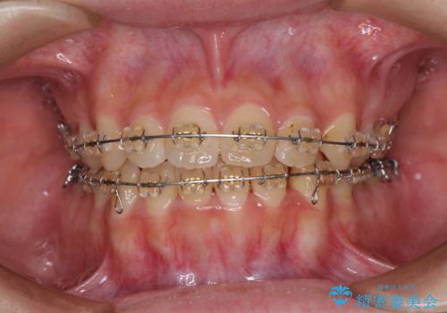 大学病院から転院 非抜歯で口元を下げるワイヤー矯正の治療前