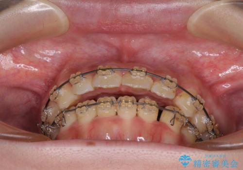 大学病院から転院 非抜歯で口元を下げるワイヤー矯正の治療前
