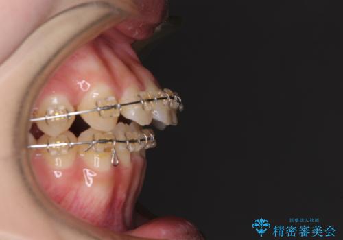 大学病院から転院　非抜歯で口元を下げるワイヤー矯正の治療前