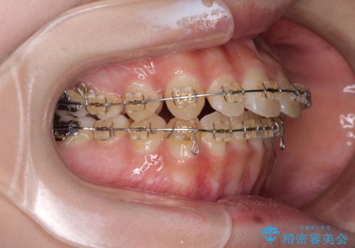 大学病院から転院 非抜歯で口元を下げるワイヤー矯正の治療前