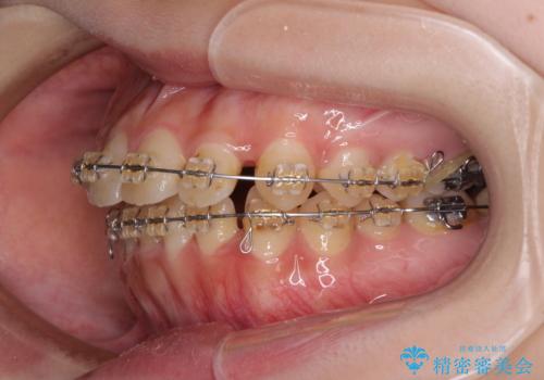 大学病院から転院　非抜歯で口元を下げるワイヤー矯正の治療前