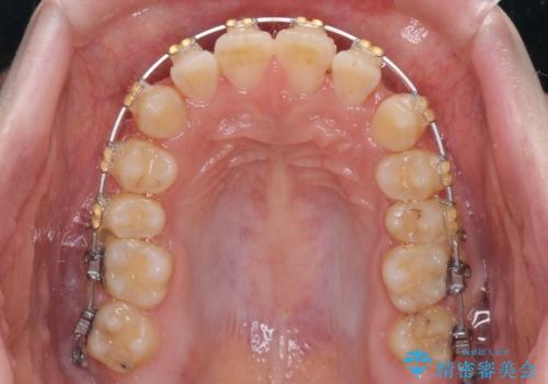 大学病院から転院 非抜歯で口元を下げるワイヤー矯正の治療前
