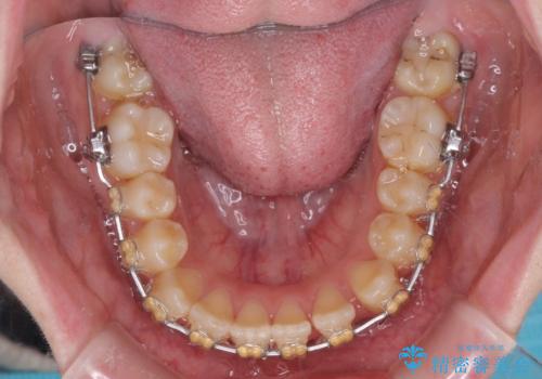 大学病院から転院 非抜歯で口元を下げるワイヤー矯正の治療前