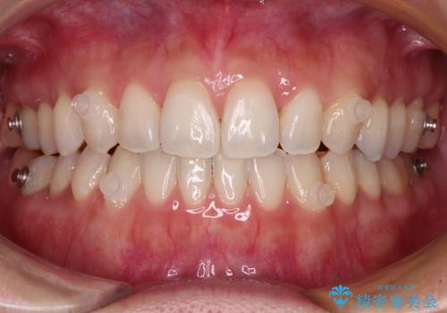 【モニター】狭い上顎歯列とオープンバイト 急速拡大装置を用いた矯正治療の治療中