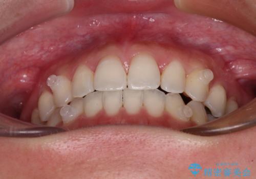 【モニター】狭い上顎歯列とオープンバイト 急速拡大装置を用いた矯正治療の治療中