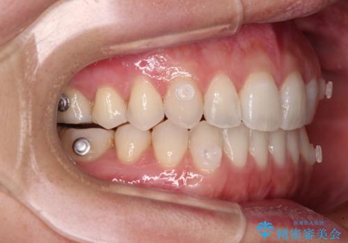 【モニター】狭い上顎歯列とオープンバイト 急速拡大装置を用いた矯正治療の治療中