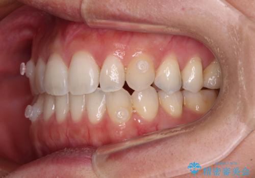 【モニター】狭い上顎歯列とオープンバイト 急速拡大装置を用いた矯正治療の治療中