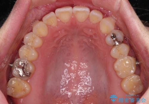 【モニター】狭い上顎歯列とオープンバイト 急速拡大装置を用いた矯正治療の治療中