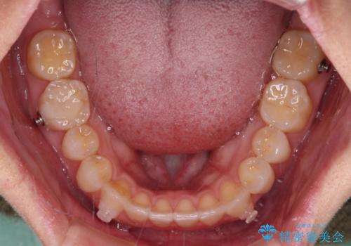 【モニター】狭い上顎歯列とオープンバイト 急速拡大装置を用いた矯正治療の治療中