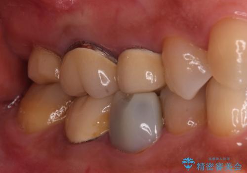 奥歯のセラミックがすぐに壊れる　欠損した奥歯へのインプラント治療の治療前