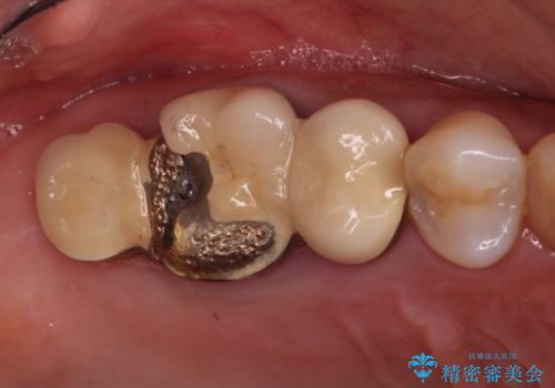 奥歯のセラミックがすぐに壊れる　欠損した奥歯へのインプラント治療の症例 治療前