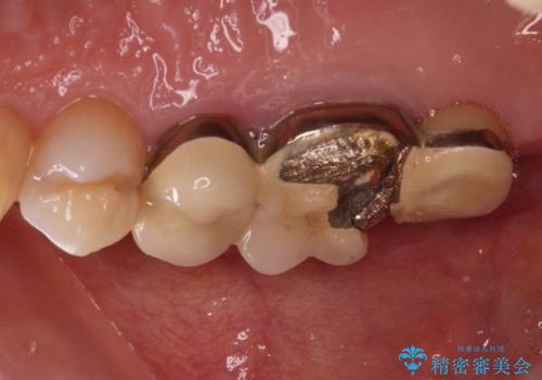 奥歯のセラミックがすぐに壊れる　欠損した奥歯へのインプラント治療の治療前