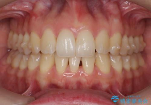 目立つ前歯のガタつきを改善! マウスピース矯正治療の治療中