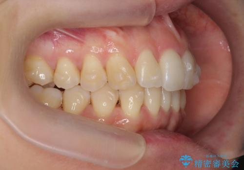 目立つ前歯のガタつきを改善! マウスピース矯正治療の治療中