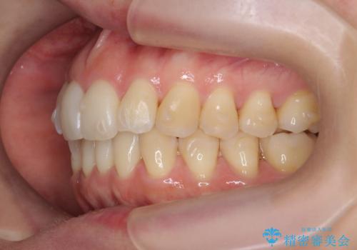目立つ前歯のガタつきを改善!　マウスピース矯正治療の治療中
