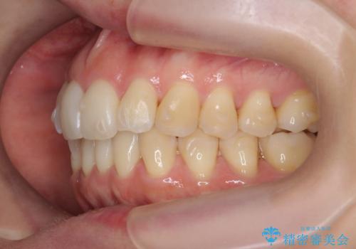 目立つ前歯のガタつきを改善! マウスピース矯正治療の治療中
