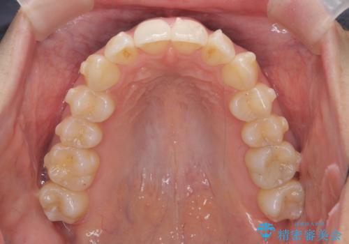目立つ前歯のガタつきを改善! マウスピース矯正治療の治療中