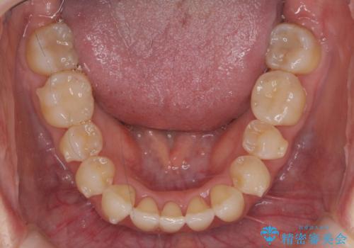 目立つ前歯のガタつきを改善! マウスピース矯正治療の治療中