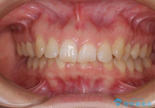 カリエール・ディスタライザーとインビザラインを用いた前歯の咬み合わせ改善の治療前