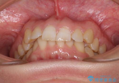 カリエール・ディスタライザーとインビザラインを用いた前歯の咬み合わせ改善の治療前