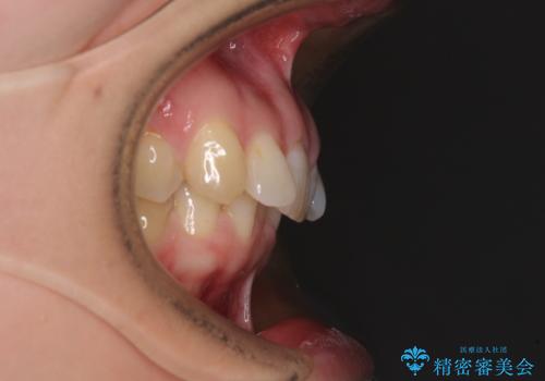 カリエール・ディスタライザーとインビザラインを用いた前歯の咬み合わせ改善の治療前