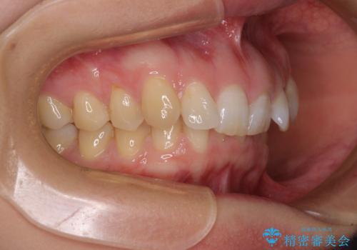 カリエール・ディスタライザーとインビザラインを用いた前歯の咬み合わせ改善の治療前