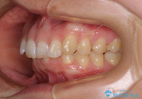 カリエール・ディスタライザーとインビザラインを用いた前歯の咬み合わせ改善の治療前