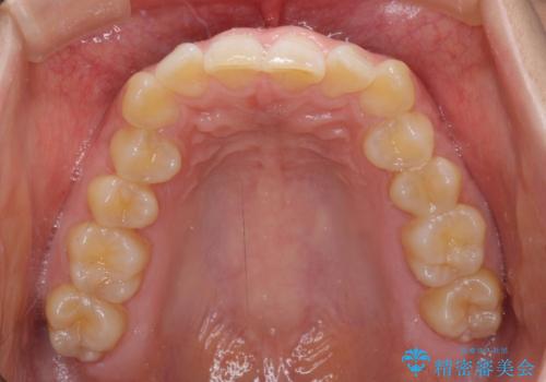 カリエール・ディスタライザーとインビザラインを用いた前歯の咬み合わせ改善の治療前