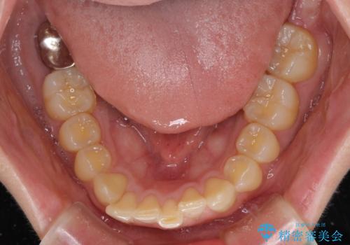 カリエール・ディスタライザーとインビザラインを用いた前歯の咬み合わせ改善の治療前