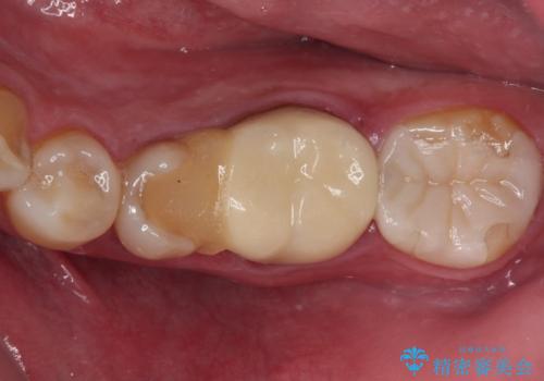 詰め物の外れてしまった奥歯 部分矯正で歯列を整えてから補綴治療の治療前