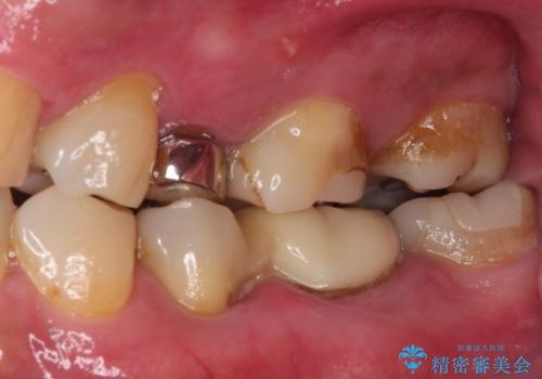 詰め物の外れてしまった奥歯 部分矯正で歯列を整えてから補綴治療の症例 治療前