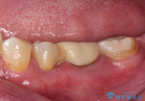 詰め物の外れてしまった奥歯 部分矯正で歯列を整えてから補綴治療の治療前
