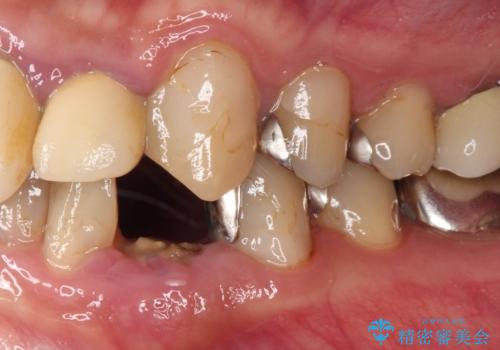 抜歯と言われた歯　部分矯正と歯周外科処置で抜かずに保存の治療前