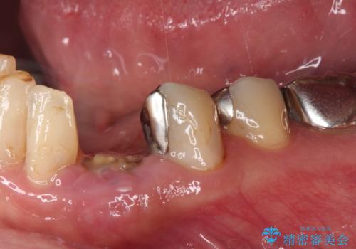 抜歯と言われた歯　部分矯正と歯周外科処置で抜かずに保存の症例 治療前