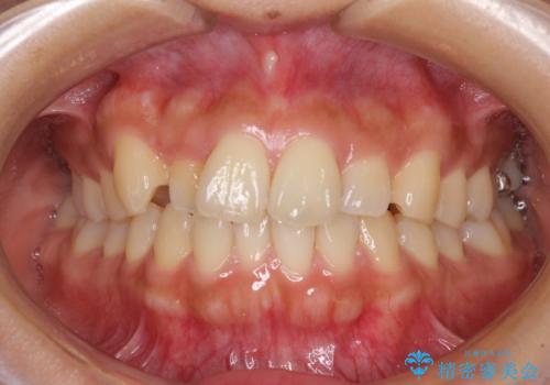 【モニター】歯列が狭くデコボコが気になる 急速拡大装置を用いたインビザライン矯正の治療前