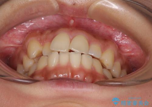 【モニター】歯列が狭くデコボコが気になる 急速拡大装置を用いたインビザライン矯正の治療前