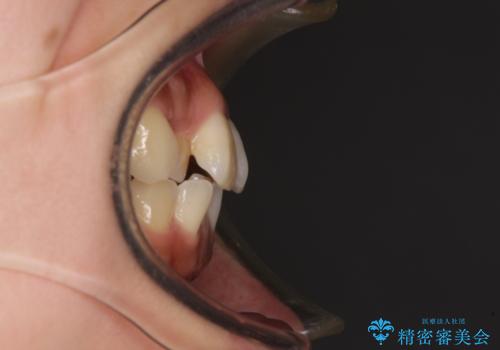 【モニター】歯列が狭くデコボコが気になる 急速拡大装置を用いたインビザライン矯正の治療前