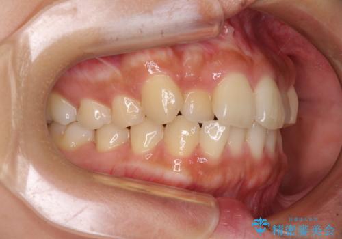 【モニター】歯列が狭くデコボコが気になる 急速拡大装置を用いたインビザライン矯正の治療前