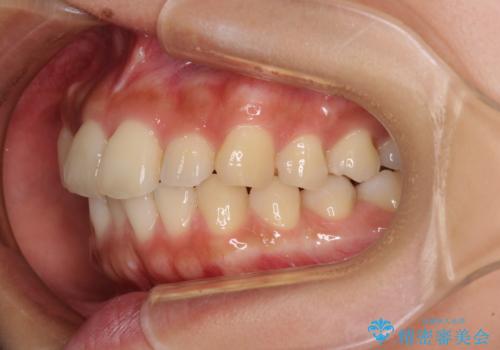 【モニター】歯列が狭くデコボコが気になる 急速拡大装置を用いたインビザライン矯正の治療前