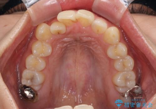 【モニター】歯列が狭くデコボコが気になる 急速拡大装置を用いたインビザライン矯正の治療前
