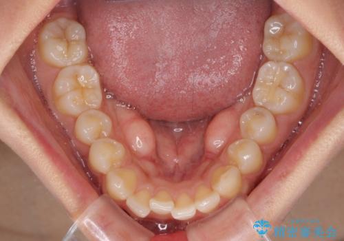 【モニター】歯列が狭くデコボコが気になる 急速拡大装置を用いたインビザライン矯正の治療前