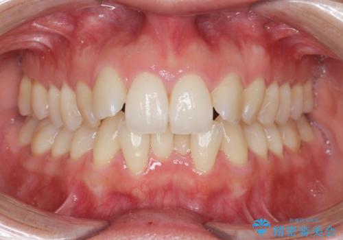 目立つ前歯のガタつきを改善!　マウスピース矯正治療の症例 治療前