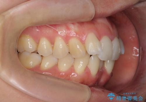 目立つ前歯のガタつきを改善! マウスピース矯正治療の治療前