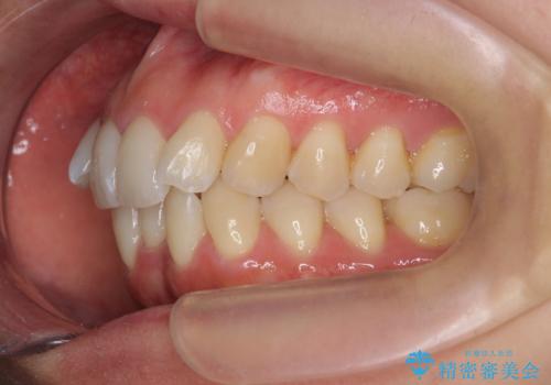 目立つ前歯のガタつきを改善!　マウスピース矯正治療の治療前
