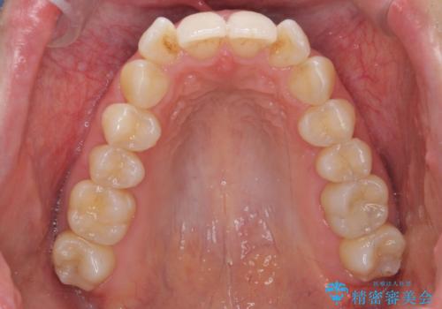 目立つ前歯のガタつきを改善! マウスピース矯正治療の治療前