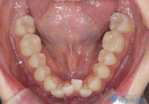 目立つ前歯のガタつきを改善!　マウスピース矯正治療の治療前